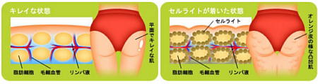 セルライト発生のしくみ